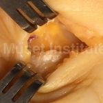 Canalicular syndromes. FAQ